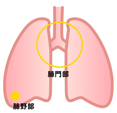 肺がん　発生場所